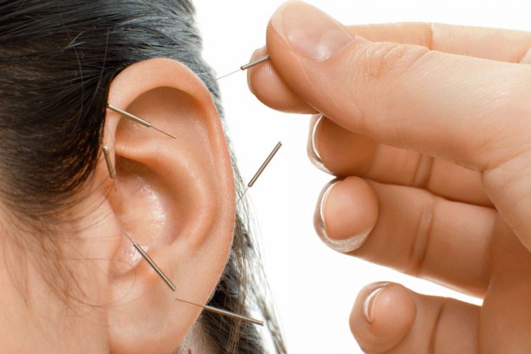 ear-acupuncture-768x512